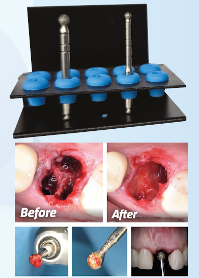 JDS抜歯窩掻把用ダイヤモンドバーキット イメージ画像